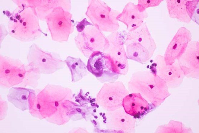 Testi i Smear (Testi i Serviks / PAP Smear): Çfarë është, Si Bëhet dhe Rëndësia e Tij