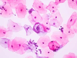 Testi i Smear (Testi i Serviks / PAP Smear): Çfarë është, Si Bëhet dhe Rëndësia e Tij