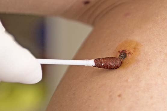 Trajtimi i HPV me Ilaç