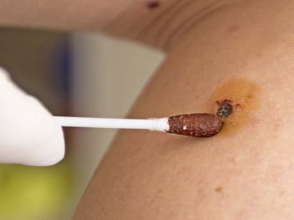 Trajtimi i HPV me Ilaç