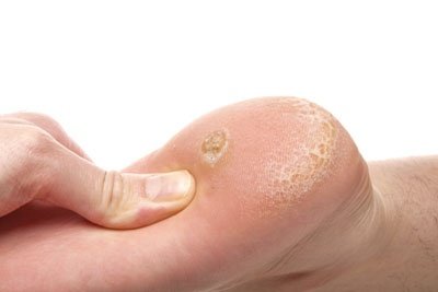 Lytha në këmbë