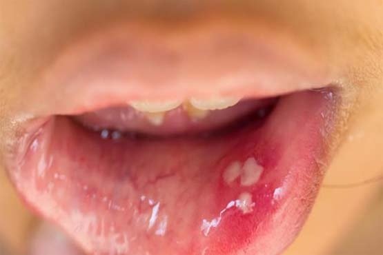 Lytha në gojë