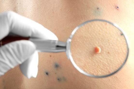 Çfarë është HPV?