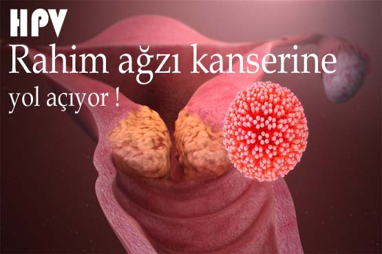 HPV dhe Kanceri