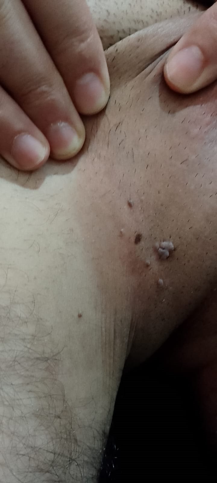 Si duken lythat në ijë 1 &mdash; Lyth në zonën e ijëve. Shfaqet sidomos në zonat që irritohen; gërvishtja dhe gjakosja mund të çojnë në shtim.