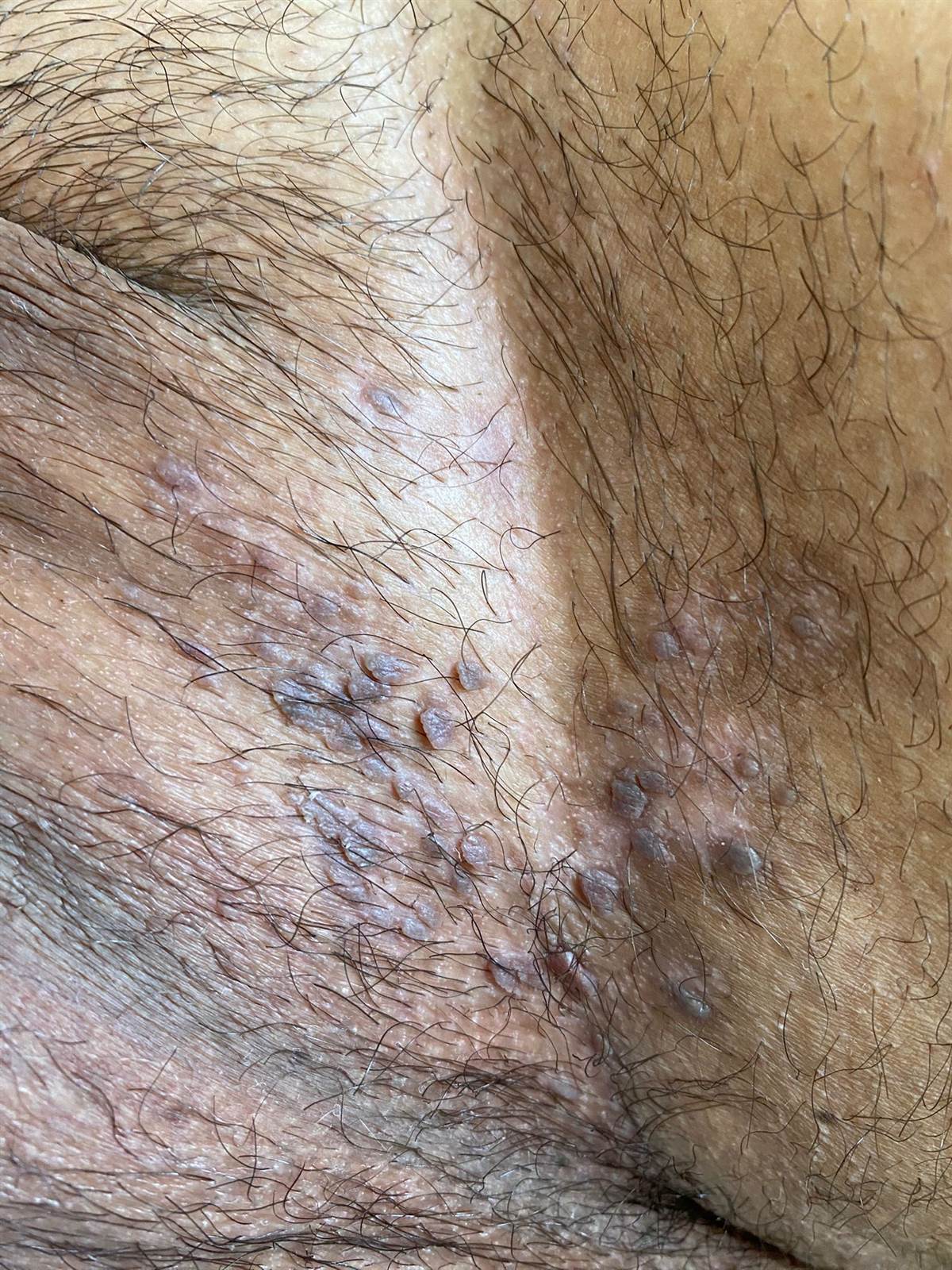 Si duken lythat në ijë 2 &mdash; Lyth në zonën e ijëve. Vërehet shpesh në zona të lagështa dhe të irrituara. Mund të ngatërrohet me fibromë të varur (skin tag) ose me molusk.