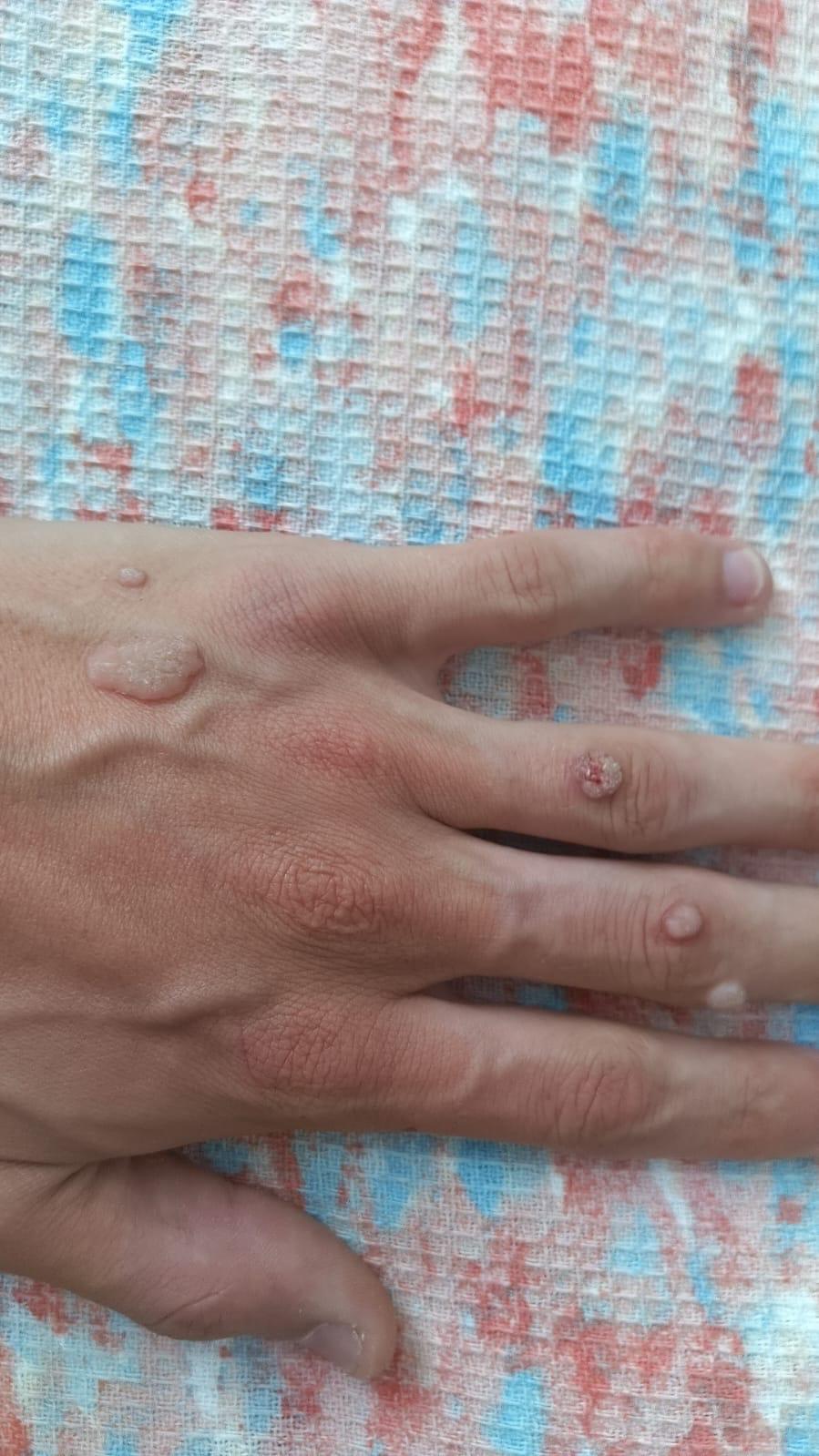 Si duken lythat në duar 2 &mdash; Lyth në gisht me sipërfaqe të ashpër, si lulelakër. Kjo pamje e vrazhdë është tipike për lythin e zakonshëm (verruca vulgaris).