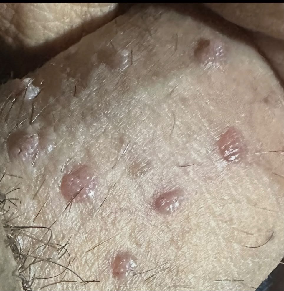 Si duken lythat në penis 1 &mdash; Kondilomë në penis. Lythat nuk kanë gjithmonë formë lulelakre; ndonjëherë janë të ngritura mbi lëkurë dhe me ngjyrë të errët (të hiperpigmentuara).