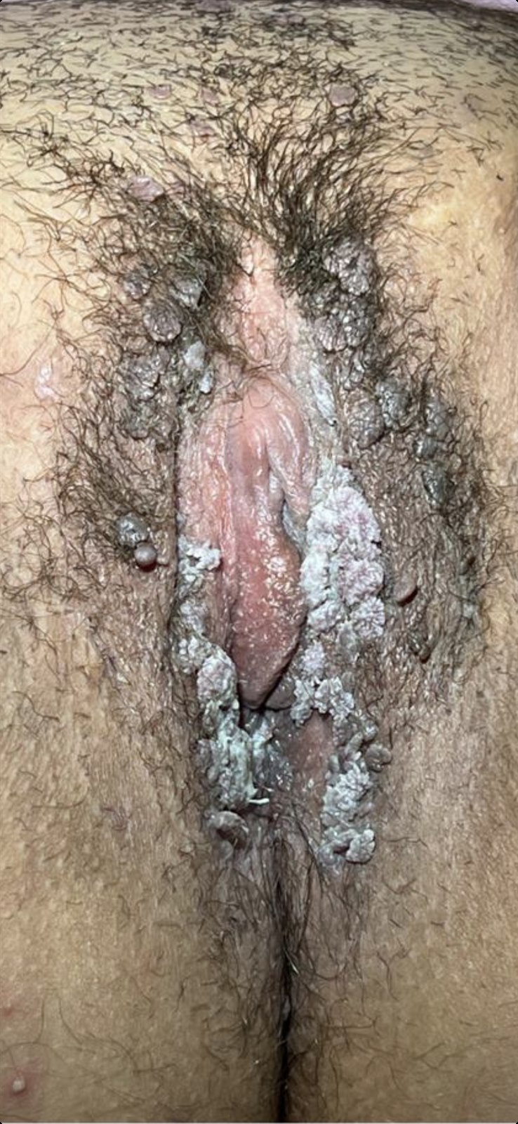 Si duken lythat në vaginë 1 &mdash; Lyth gjenital (kondilomë) në hyrjen e vaginës dhe rreth saj.