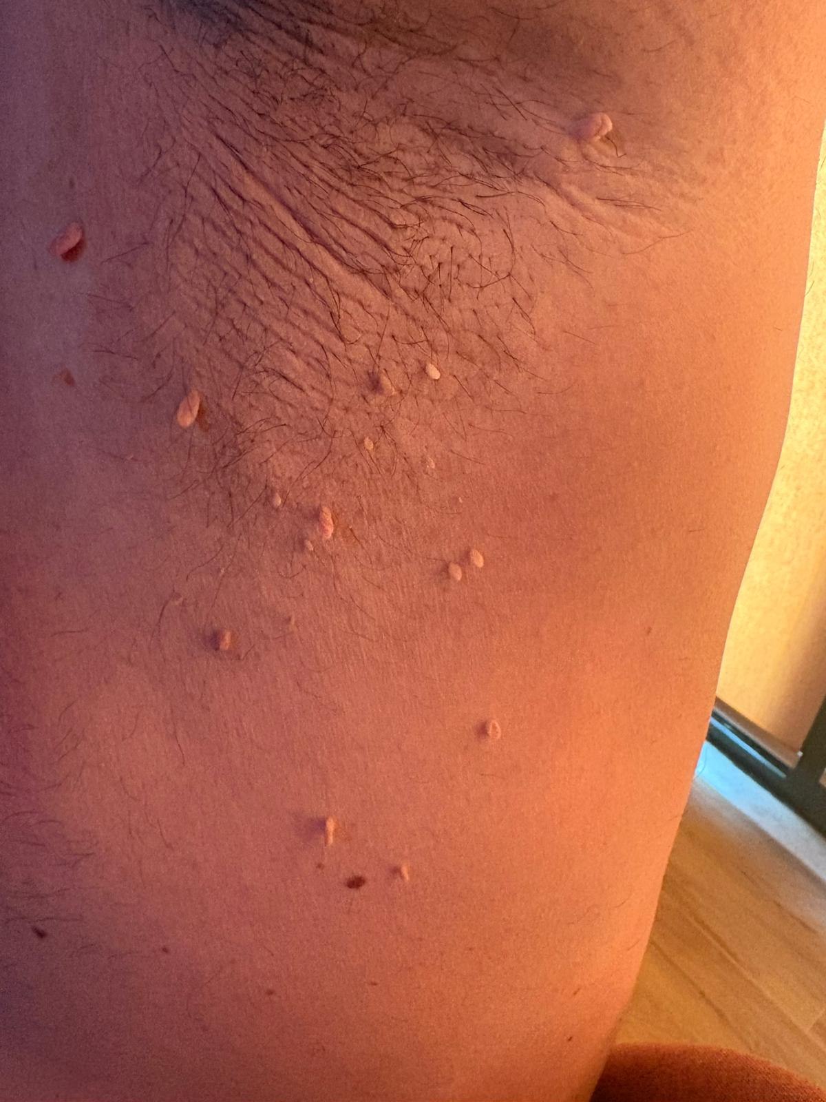 Si duken lythat në trup 2 &mdash; Fibromë e varur (skin tag) nën sqetull. E butë, me këmbëz dhe në ngjyrë të lëkurës — nuk lidhet me HPV dhe nuk është ngjitëse.